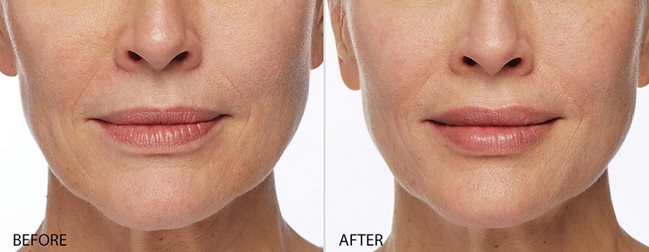 Lip Augmentation - Before and After