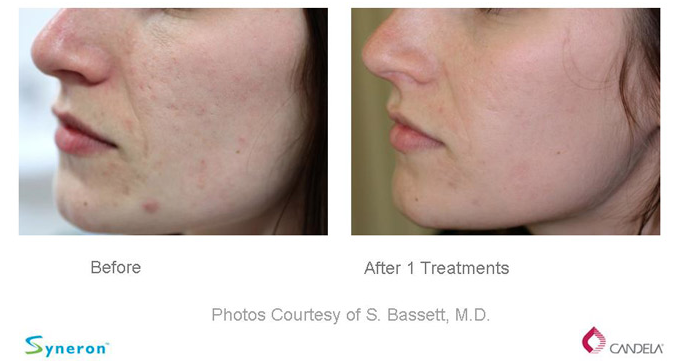 Before and After - Sublative Rejuvenation-eMatrix 1