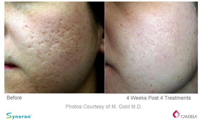 Sublative Rejuvenation - Before and After